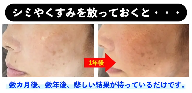 シミやくすみを放っておくと